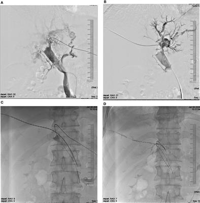 Endovascular brachytherapy with iodine-125 seed strand for extensive portal vein tumor thrombus in patients with hepatocellular carcinoma